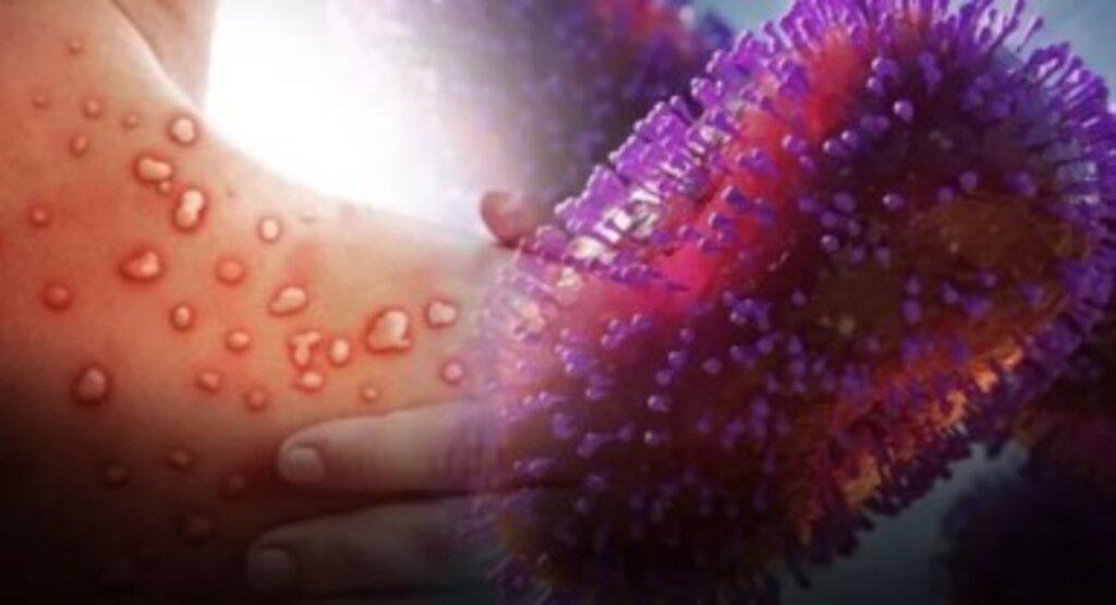 Maymun Çiçeği bir ülkede daha görüldü! Yeni tehdit yayılmaya devam ediyor