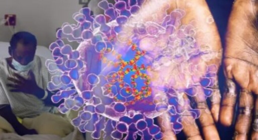 Maymun Çiçeği virüsü Avrupa’da görüldü!