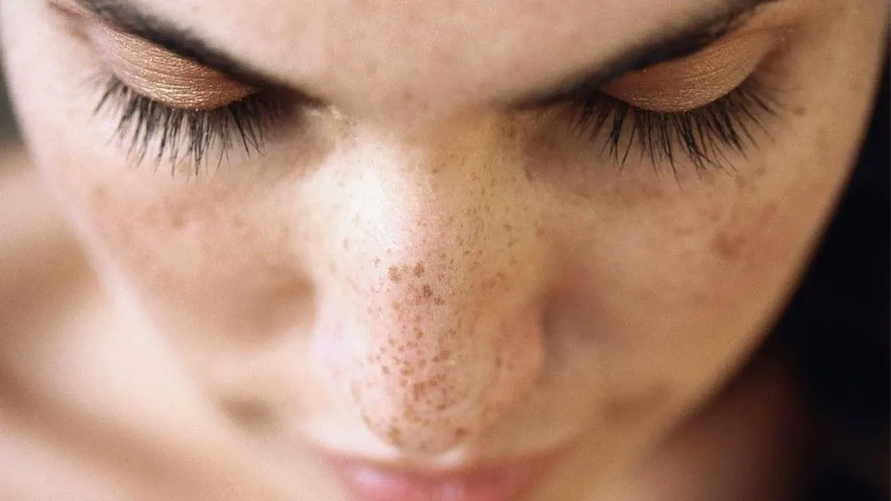 Yüzdeki Kahverengi Benler Nasıl Geçer