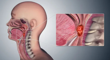 Gırtlak Kanserinde Düzenli Muayene Tedavi Başarısını Belirliyor
